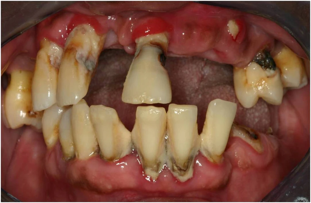 SPOILER_Doenca-periodontal---Caso-clinico preview
